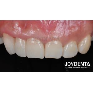 Painless Procedure BOPT Dental Technique for Accurate Tooth Preparation