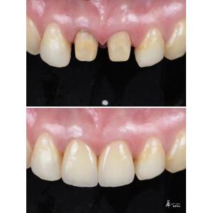 Buy cheap Veneers Made With High Fracture Resistance Dental Zirconia And Multilayered Gradient Technology from wholesalers