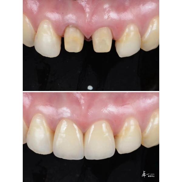 Veneers Made With High Fracture Resistance Dental Zirconia And Multilayered