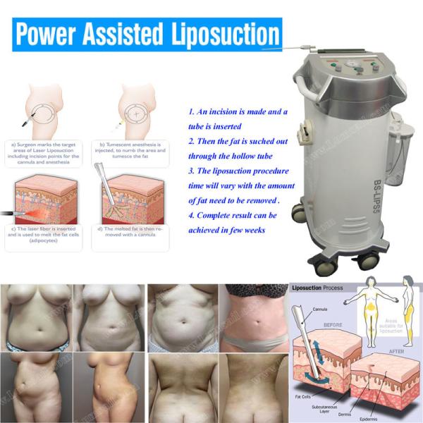 Quality BS-LIPS5 cannula sales body slimming power assisted liposuction machine for sale