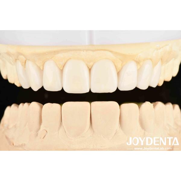 Dental's Good Elasticity And Tooth Arrangement Technology Flexible Denture