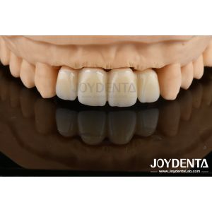 Biologically Oriented Preparation Technique BOPT For Accurate Dental Preparation