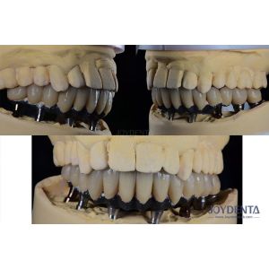 Buy cheap Titanium Multiple Teeth Dental Implant Prosthetic Surgery External Hexagon Connection from wholesalers