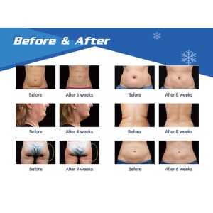 Buy cheap 5 Handles Cryolipolysis Fat Freezing Machine , Multifunctional Cavitation RF Cryolipolysis Machine from wholesalers