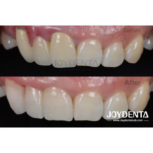Buy cheap Painless Procedure BOPT Dental Technique for Accurate Tooth Preparation from wholesalers