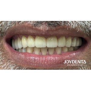 Buy cheap Zirconia dentures that imitate natural teeth from wholesalers