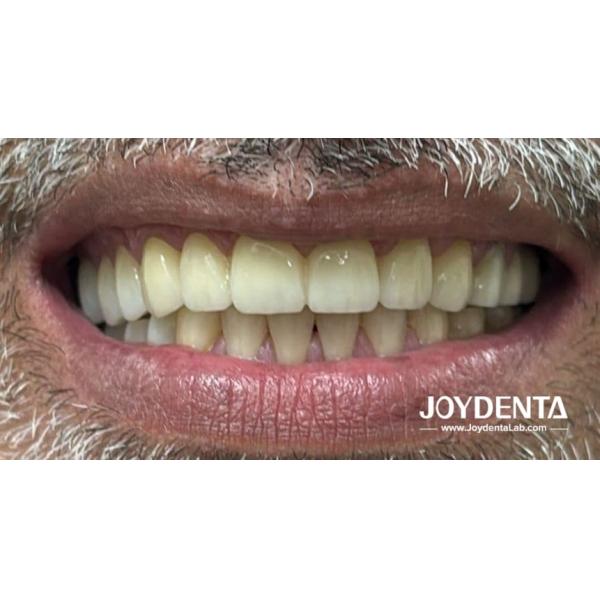 Quality Zirconia dentures that imitate natural teeth for sale