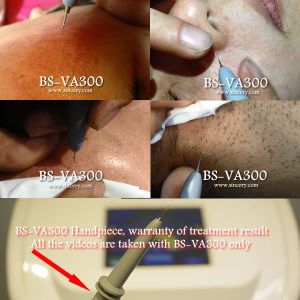 Buy cheap Non Invasive 30MHz Vascular Age Spot Removal Machine from wholesalers