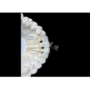 Natural-Looking Zirconia Ceramic Crown Bridge Provides Precision And Aesthetics