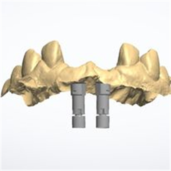 Quality 3D model Zirconia crown for sale