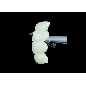 Natural-Looking Zirconia Ceramic Crown Bridge Provides Precision And Aesthetics