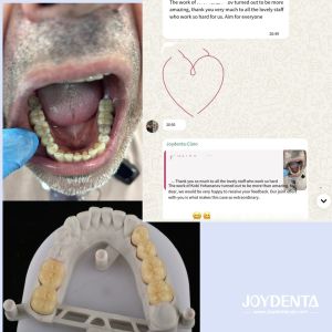 Buy cheap Zirconia dentures that imitate natural teeth from wholesalers