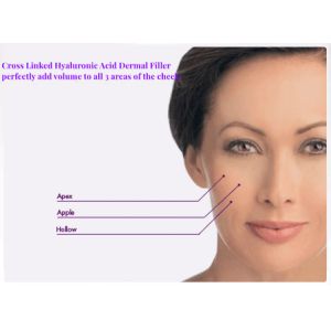 Injectable Sodium Hyaluronate Dermal Filler Midface Volume Loss Treatment Plump