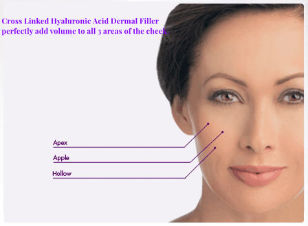Injectable Sodium Hyaluronate Dermal Filler Midface Volume Loss Treatment Plump