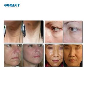 Buy cheap Desktop Morpheus8 Depth8 Facial Machine Cold Hammer Body Face 2handles Skincare Vertical Fractional RF Wrinkle Remove from wholesalers