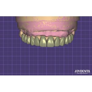 HIPAA Compliant Data Security Digital Wax Up 3D Model For Dental Modifications