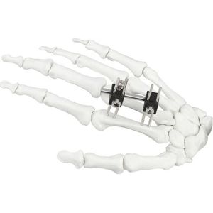 Orthopedic Surgical Mini Fragment Ilizarov External Fixation Device