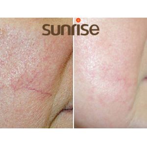 Buy cheap 980nm diode laser for lipolysios/ nail fungus removal/vascular removal from wholesalers