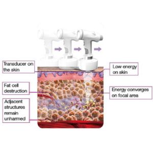 factory hifu high intensity focused ultrasound hifu
