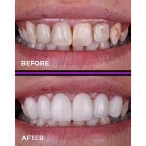 YUCERA 1200MPa 98 HT Dental Zirconia Blocks Dental Consumable Pre Shaded