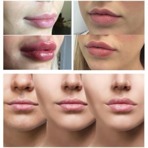 China Smooth Lines / Plump Lips With Hyaluronic Acid Injectable Filler 1ml 2ml 5ml on sale