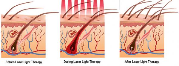 Buy cheap Laser hair regrowth Low Level Laser Hair Restoration Lamp Laser hair care hair loss from wholesalers