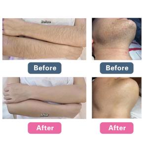 Buy cheap Picosecond Laser Facial Rejuvenation Machine , Q Switched Tattoo Removal Machine from wholesalers