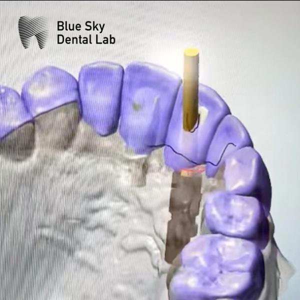 Quality Sandblasted ASC Abutment Pure Titanium Angulated Screw Channel Abutment for sale