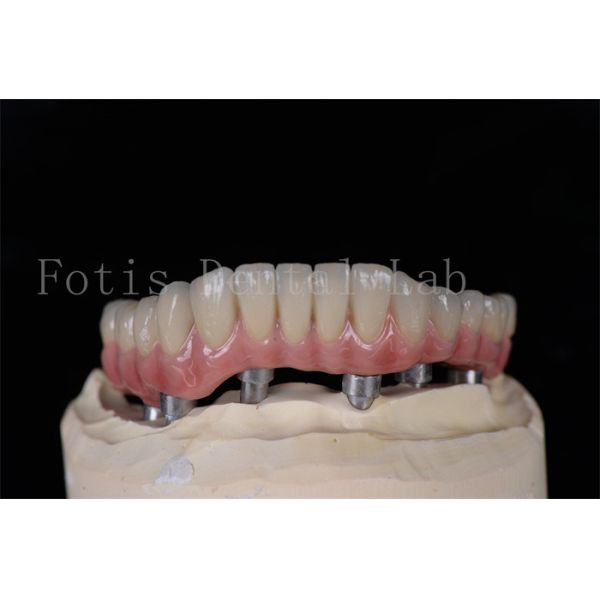 Minimally Invasive Same Day All On 4 All On 6 Implants Natural Looking Easy To