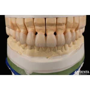 High Translucency Layered Zirconia Crowns Bridges Dental Restorations lifelike