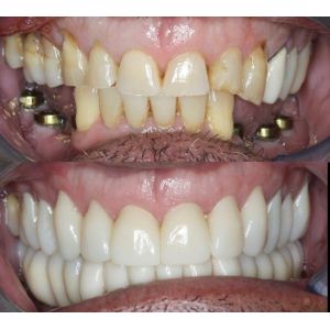 Buy cheap Yucera 4D Pro Multilayer Zirconia Blocks Advanced Dental Technology from wholesalers