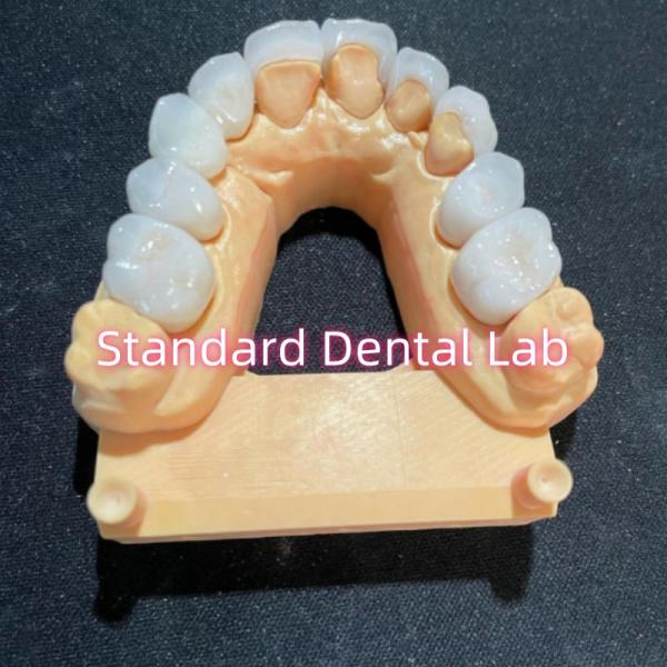 Quality High Esthetic Hollywood Smile Milling Emax Laminate Veneers for sale