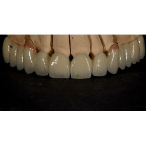 Buy cheap Good Fitting Good Esthetics Multi Layered Zirconia Crown Porcelain Zirconia Bridge from wholesalers