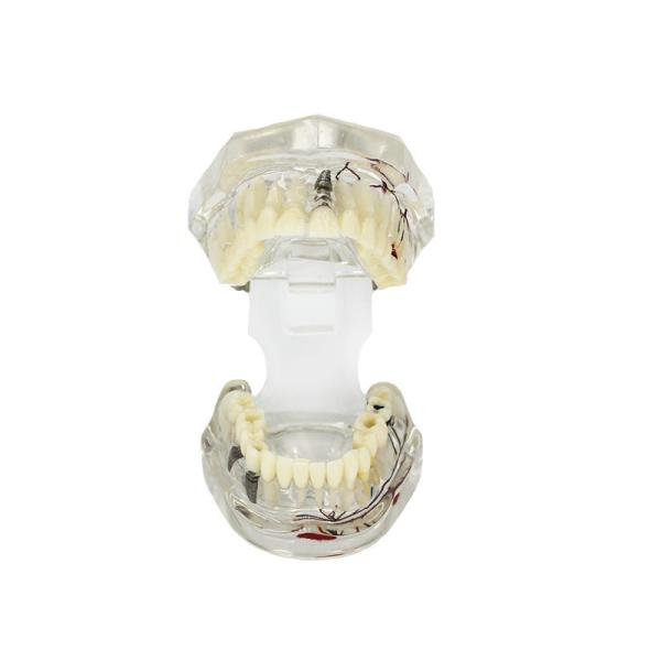 Quality Transparent Pathological Tooth Model Dental With Tooth Nerve Customization for sale