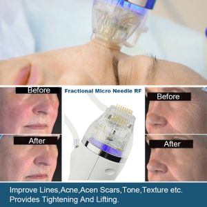 Buy cheap DPL Anti Aging Micro Needling Scarlet Face Lifting Fractional RF Microneedling Machine from wholesalers