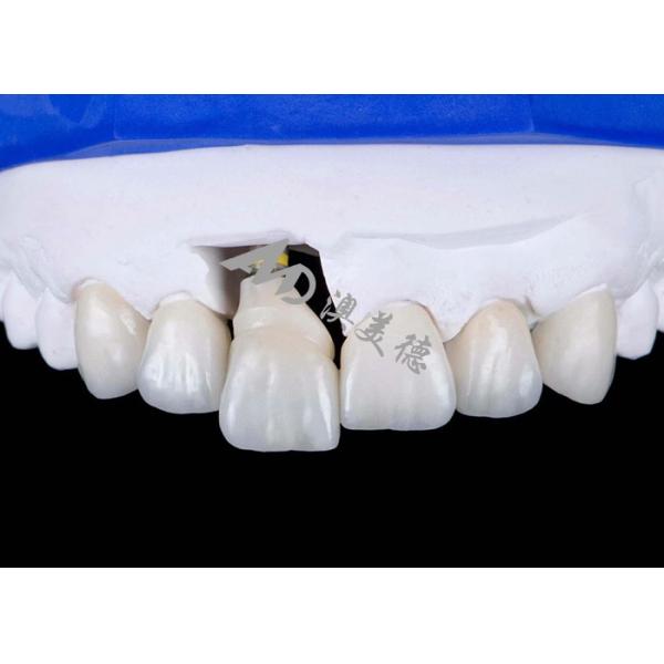Buy cheap Dental Implant Crown with Titanium Abutment For Natural Looking Smiles from wholesalers