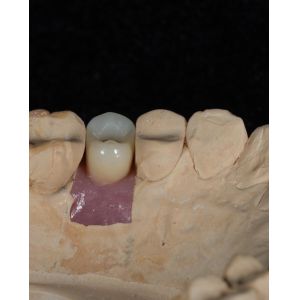 Buy cheap Screw Cement Retained Implant For Long-Lasting Dental Implants With 5-Year Guarantee from wholesalers