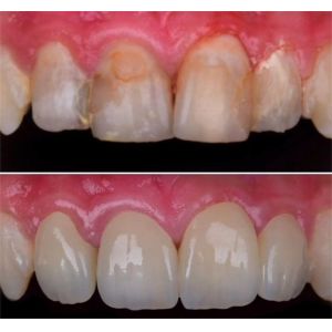 Yucera 4D-Multilayer 4D Pro Multilayer Zirconia Disc Disk Block CAD CAM Dental