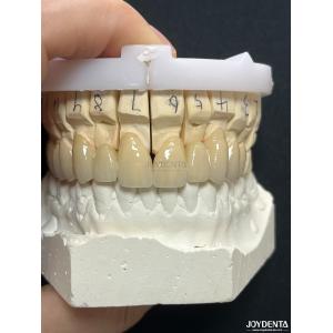 Buy cheap Seamless PFM Porcelain Fused Metal Crown For Long Term Biocompatible Restoration from wholesalers