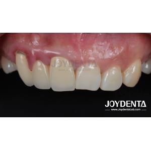 Buy cheap Painless Procedure BOPT Dental Technique for Accurate Tooth Preparation from wholesalers