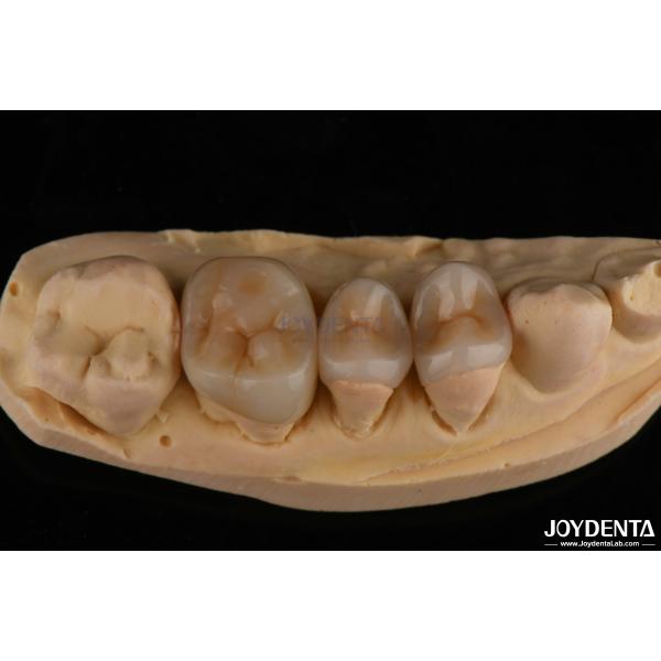 Quality Natural Looking Emax Inlay Onlay Long Lasting Dental Restoration 0.5mm 1mm 1.5mm Thick for sale