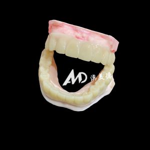 China Lightweight PMMA Temporary Bridges with Hollow Design for Implant Restorations on sale