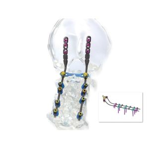 Buy cheap Posterior Cervical Internal Spine Fixation System , Pedicle Screw System from wholesalers