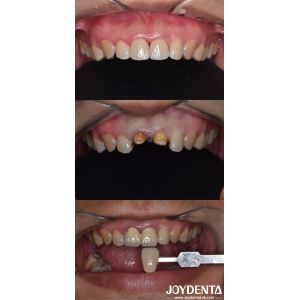 Buy cheap Biologically Oriented Preparation Technique Dental vertical Preparation product