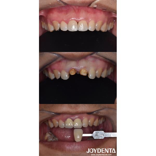 Biologically Oriented Preparation Technique Dental vertical Preparation
