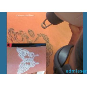 Buy cheap Nd Yag Q Switch 2000mj 532nm Laser Tattoo Removal Machine from wholesalers