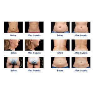 Buy cheap cryolipolysis cavitation and RF multifunctional cryolipolysis slimming machine from wholesalers