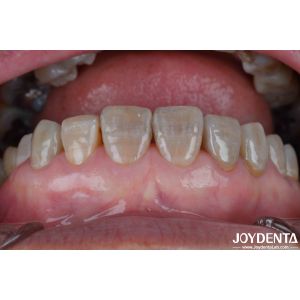 Buy cheap Lightweight Dental Zirconia For Optimal Patient Experience Natural Color Transitions And Biocompatibility Guaranteed from wholesalers