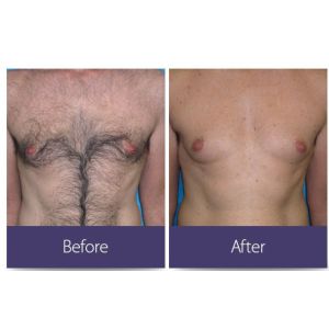 2022Newest 4K 1600W Triple wave Platinum Titanium/808nm laser diode hair removal