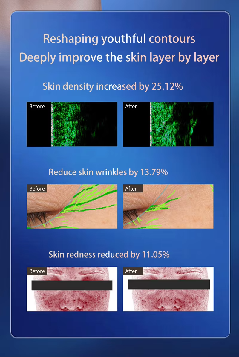 Anti Aging 2 In 1 Rf Hifu With Ice Hammer Skin Tightening Skin Care Machine